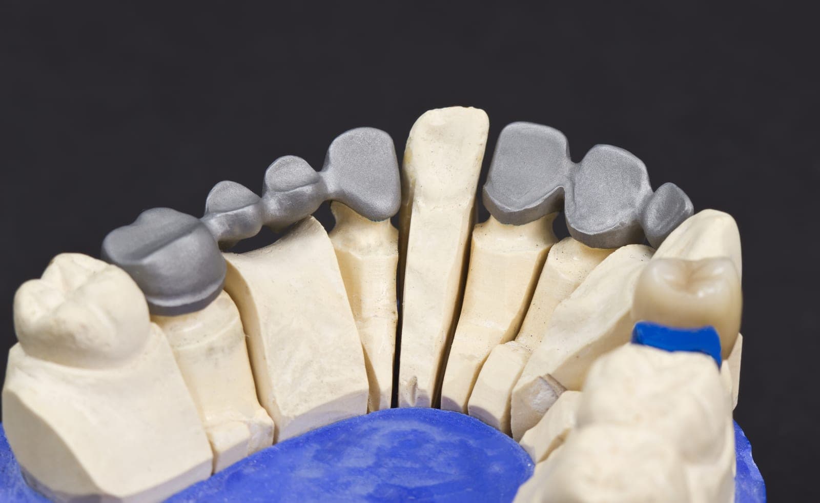 Cast metal partial denture with precision clasps